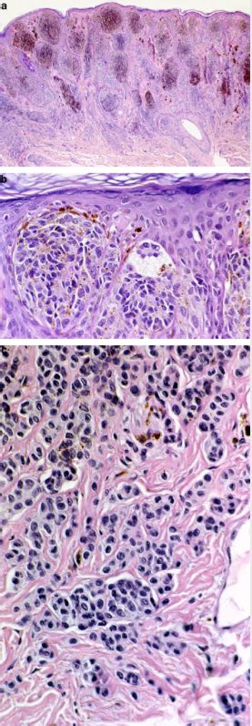 Pathology Outlines Atypical Melanocytic Nevi Of The Genital Type