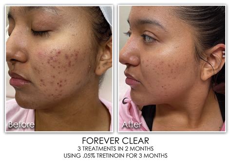 Forever Clear Acne Skin Rejuvenation Clinic Skin Rejuvenation Clinic