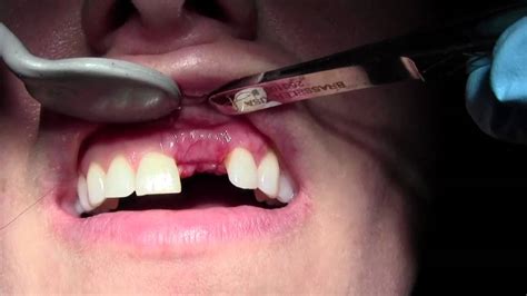 Pain 4 Weeks After Dental Bone Graft Causes Symptoms And Treatment