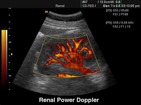 Ultrasound Images • Kidney Power Doppler Echogramm №98