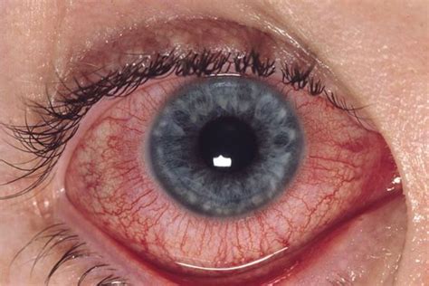 Inflamed Red Eye Basicmedical Key