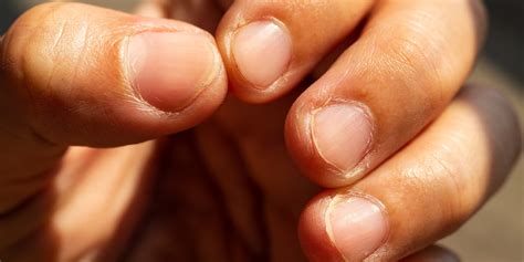 Black Spots On Fingernails