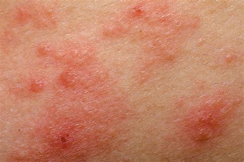What Causes Red Burning Rash On Face