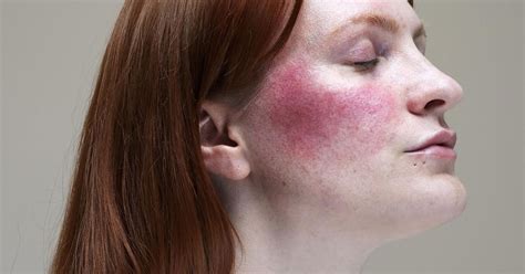 Myths I Was Told And Believed About Rosacea