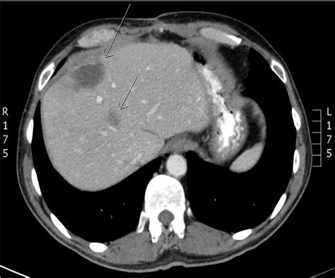 Ct Of The Liver With Contrast Showing Two Lesions In Segment Viii