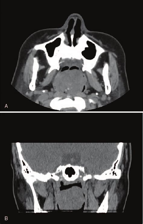 A Horizontal View Image Of Headneck Ct Scans Shows A Protruding Mass