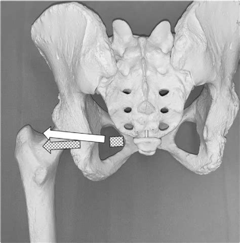 Direction Of The Obturator Externus Meshed Arrow And Obturator