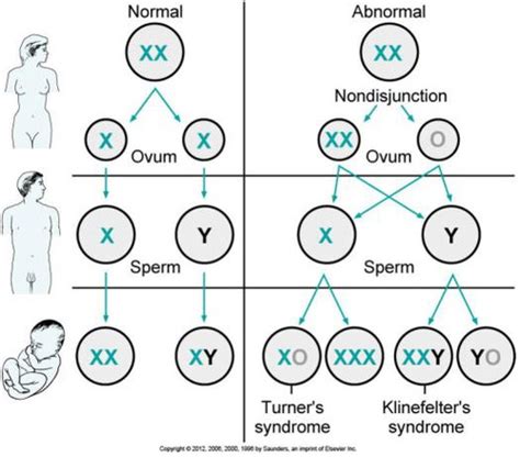 Turner Syndrome On Emaze