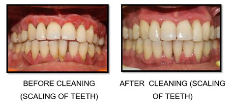 Dental Scaling Removes The Calcified Plaque Called Teeth Tartar And