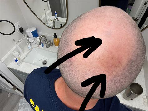 Small bruised (in appearance) dent on top of head + large brown area