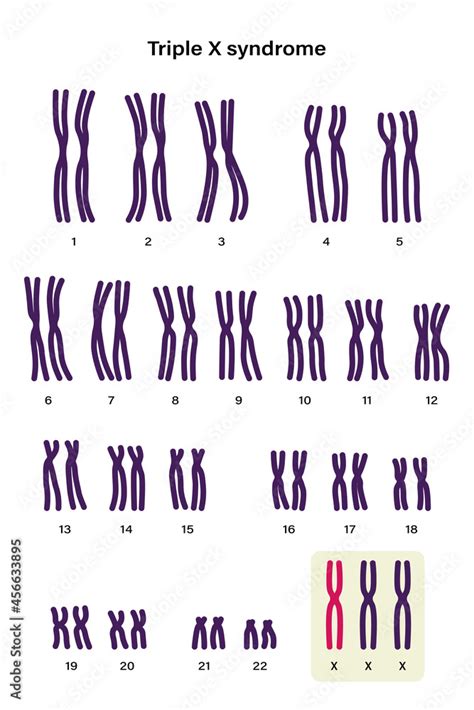 Human Karyotype Of Triple X Syndrome Xxx Female Has An Extra X