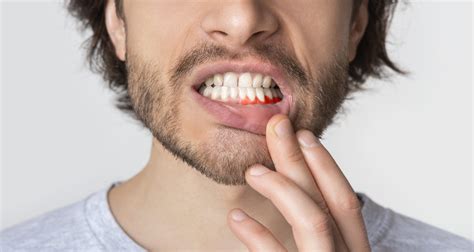 6 Causes Of Itchy Gums Treatments And Prevention