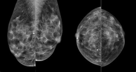 Initial Mammogram Reveals The Breast Parenchyma To Be Predominantly