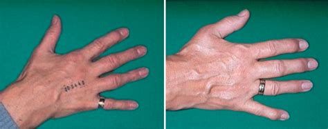 Rheumatische Hand Ursachen Diagnose Therapien 2022
