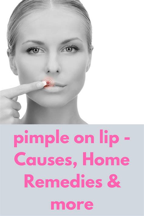 Pimple On Lip Causes Home Remedies And More This Article Describes In
