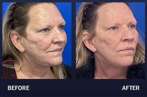 CO Laser Resurfacing Before After Pictures Madnani Facial Plastic Surgery