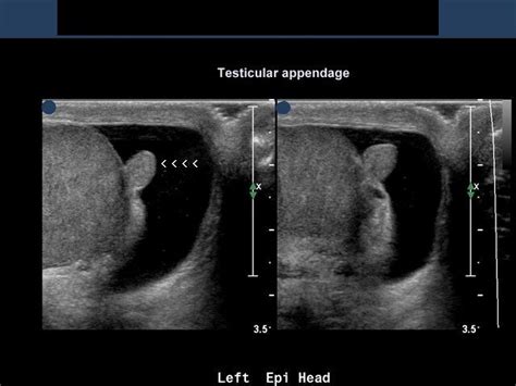 On Radiology 3 D Ultrasound Image Of Appendix Of Testis