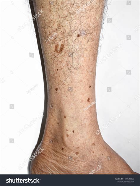 Age Spots On Leg Hairy Skin Foto Stock Editar Agora 1489533359