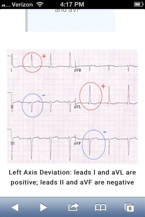 Net positive qrs complex in lead i but negative in lead ii. Left axis on 12 lead http://lifeinthefastlane.com/ecg ...