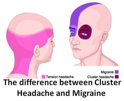 The Difference Between A Headache And A Migraine Cluster Headaches