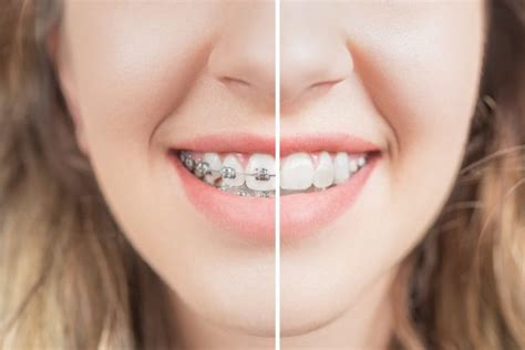 Teeth Whitening After Braces Fitchburg Super Dental Of Fitchburg