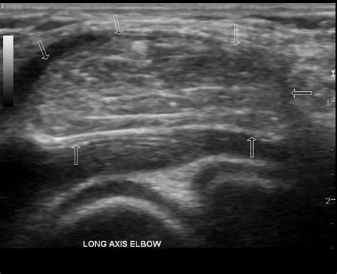 Elbow Lipoma Image