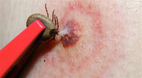 Brown Recluse Bite Pictures Stages Symptoms And Treatment Hubpages