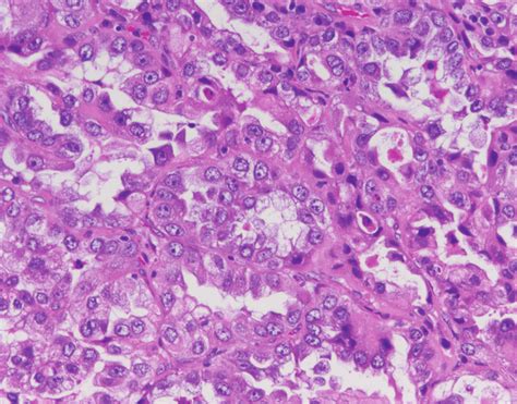 Representative Hande Staining Of Ovarian Clear Cell Carcinoma Download