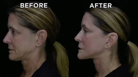 Unbelievable Before And Afters Of Neck Lift Youtube