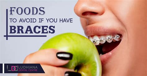 Foods To Avoid If You Have Braces