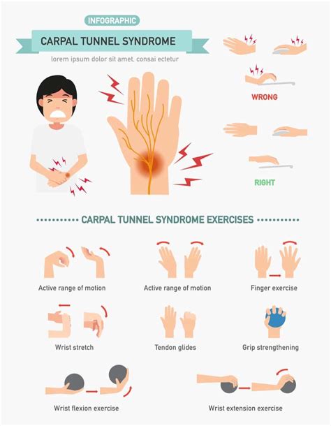 Carpal Tunnel Syndrome Cts Hand And Wrist Exercises Carpal Tunnel