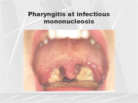 Differential Diagnosis Of Pharyngitis Main Inflammatory Throat