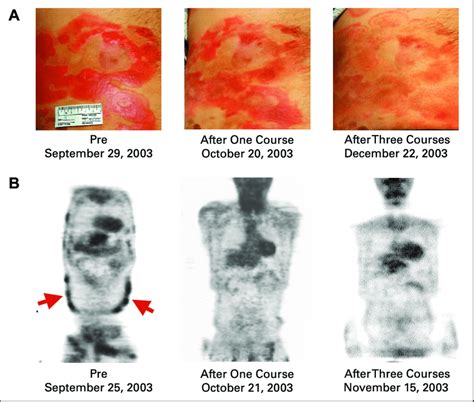 Cutaneous T Cell Lymphoma A Photographs Of Skin Lesions On The Days