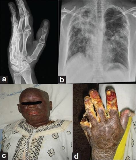 Secondaries In The Hand Ab X Ray Shows Metastasis To Thumb Cd