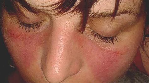 Lupus Rash Vs Rosacea Pictures And How To Tell The Difference 2023