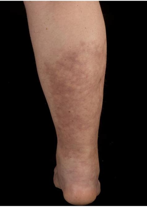 A Case Of Polyarteritis Nodosa Limited To The Right Calf Muscles