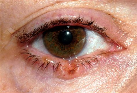 Eyelid Tumours Bopss