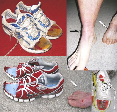 The Foot In Multistage Ultra Marathon Runners Experience In A Cohort