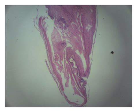 Pathologic Findings Of The Lower Esophagus Revealed Squamous Cell