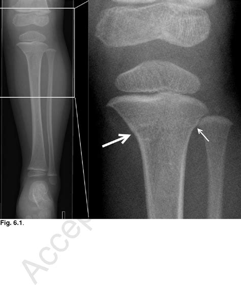Buckle Fracture Upper Tibia Hus I Norge