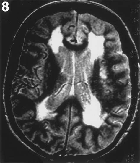 Presence And Severity Of Cerebral White Matter Lesions And Hypertension