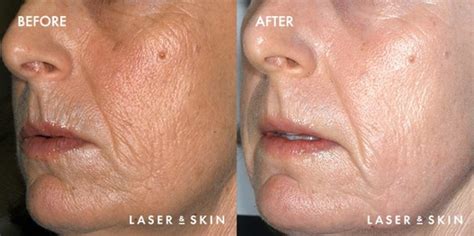 Co2 Laser Resurfacing Skin Resurfacing Sacramento Ca