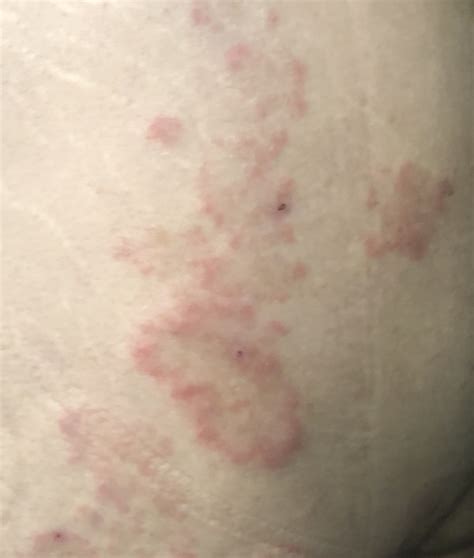 What Kind Of Rash Is This Is It A Fungal Skin Infection