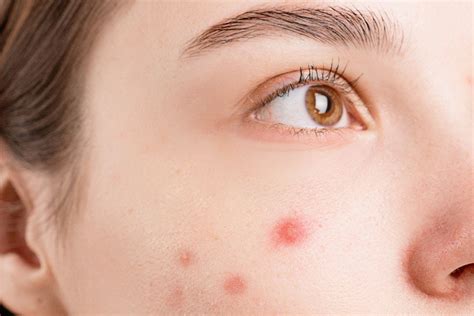 Boil Vs Pimple How To Spot The Differences Gleamin