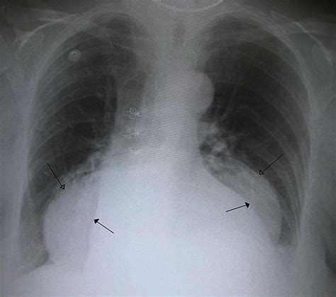 Medicinehiatal Hernia Handwiki