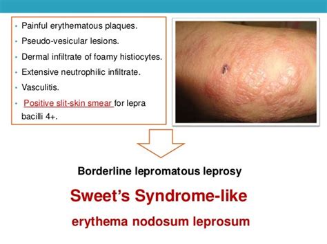 Atypical Presentations Of Erythema Nodosum Leprosum A Case Report An