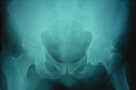 Anteroposterior Radiograph Of The Hip At Presentation Download