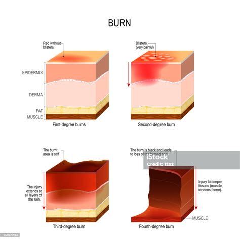 피부 화상 4도 화상의 태우기에 대한 스톡 벡터 아트 및 기타 이미지 태우기 피부 다이어그램 Istock