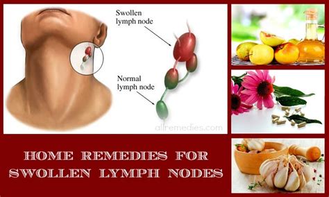 Lymph Node Pain Relief
