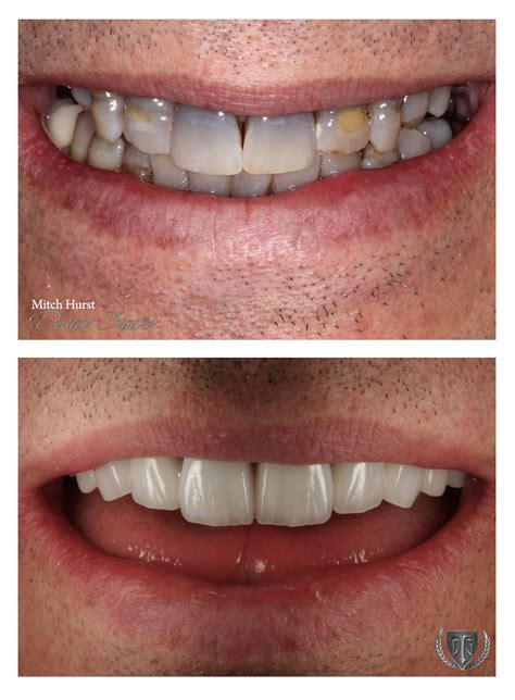 Smile Makeover Before And After Dental Cosmetic Beautiful Smile